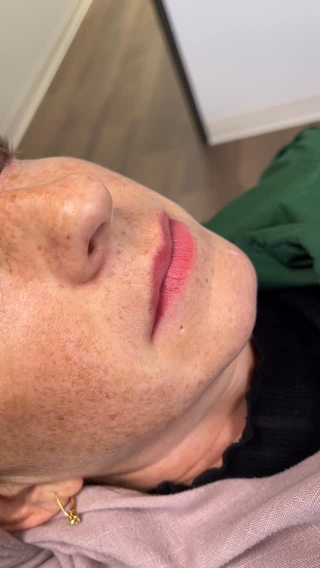 Initially, our client came in for a removal of her exisitng lip blush by an another artist two years ago. She was dissatisfied with the color and outline shape.
She asked if we could redo her Lip Blushing after the removal service. As a professional and artist, it was important to understand her desired lip color and desired shape. She agreed that she wanted a more nude pink instead of the bright pink lip hue she received. We could achieve this through bypassing the removal service and going straight into neutralizing and toning the exisitng bright pink ink with @evenflocolours Illume and Malina. This gave her a natural pink with a warm undertone. They are now the perfect color, with fullness, shape and symmetry. She will need one more session and we are excited to see her healed results!
Book With Us Today!
#lipfiller #liptattoo #lipblush #lipneutralization